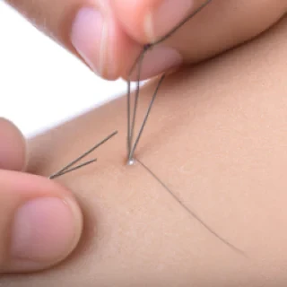 Acupuncture